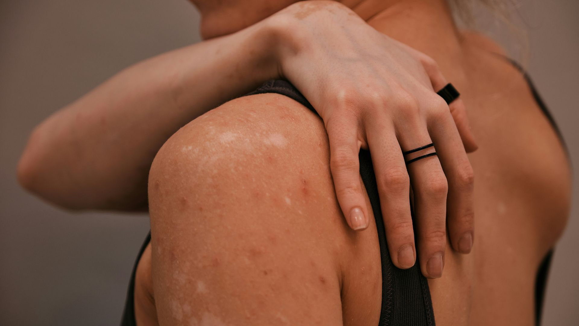 As the number of measles cases linked to an Upstate outbreak continues to rise, South Carolina state health authorities advise residents to be especially careful during the holiday season